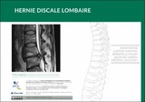 Hernie discale lombaire