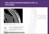 Les maladies rhumatismales dans la colonne