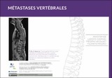 Métastases vertébrales