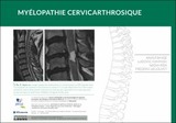 Myélopathie cervicarthrosique