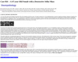 Pathology Case Study: 47-year Old Female with a Destructive Sellar Mass